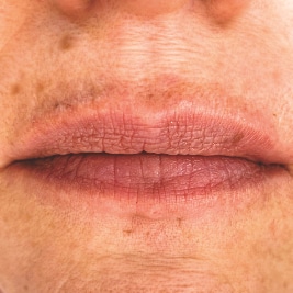 gemeinschaftspraxis dreo Mesotherapie Pforzheim Faltenbehandlung lippen aufspritzen ästhetische medizin hyaluron behandlung Pforzheim lippen contouring