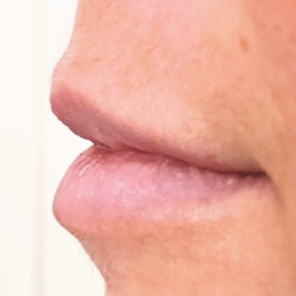 gemeinschaftspraxis dreo Mesotherapie Pforzheim Faltenbehandlung lippen aufspritzen ästhetische medizin hyaluron behandlung Pforzheim lips